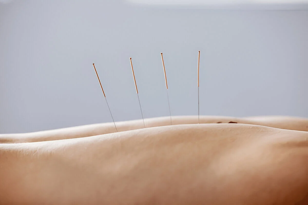 Acupuncture, needles and treatment of body in healthcare, healing muscle and back pain relief