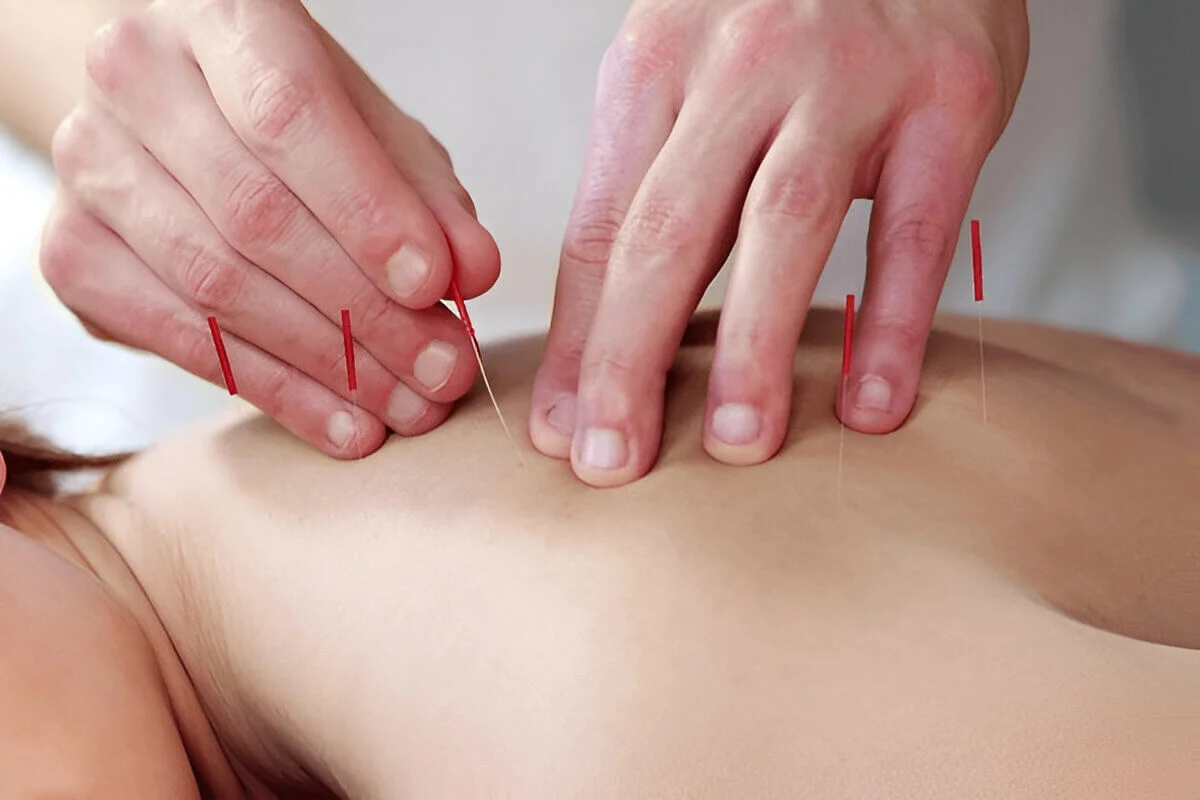 Cupping therapy with needle acupuncture for dry massage treatment