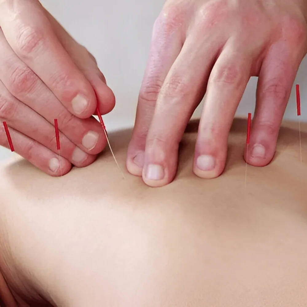 Cupping therapy with needle acupuncture for dry massage treatment